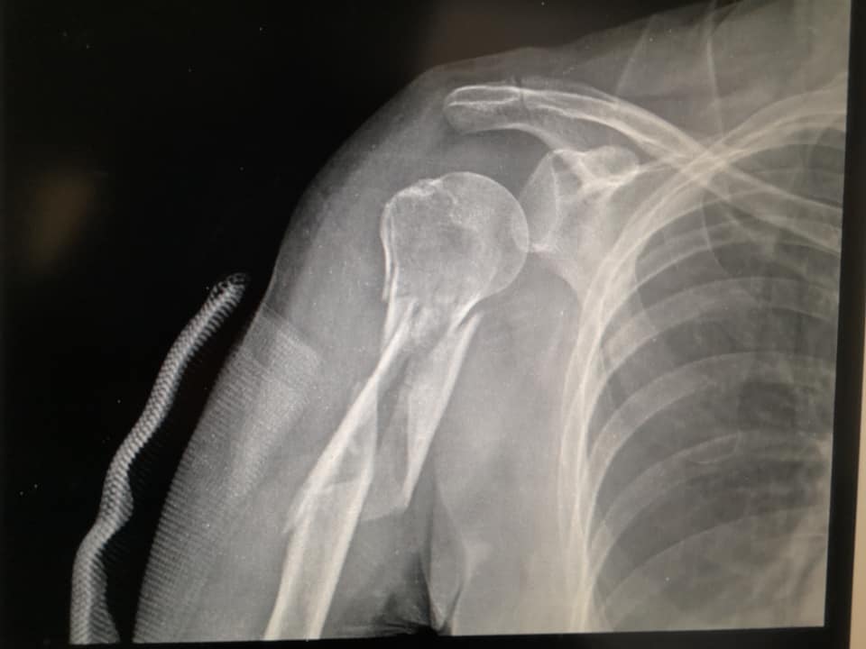 Radiografía de hombro humano con huesos y estructura ósea visible.