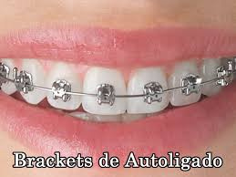 Brackets autoligado