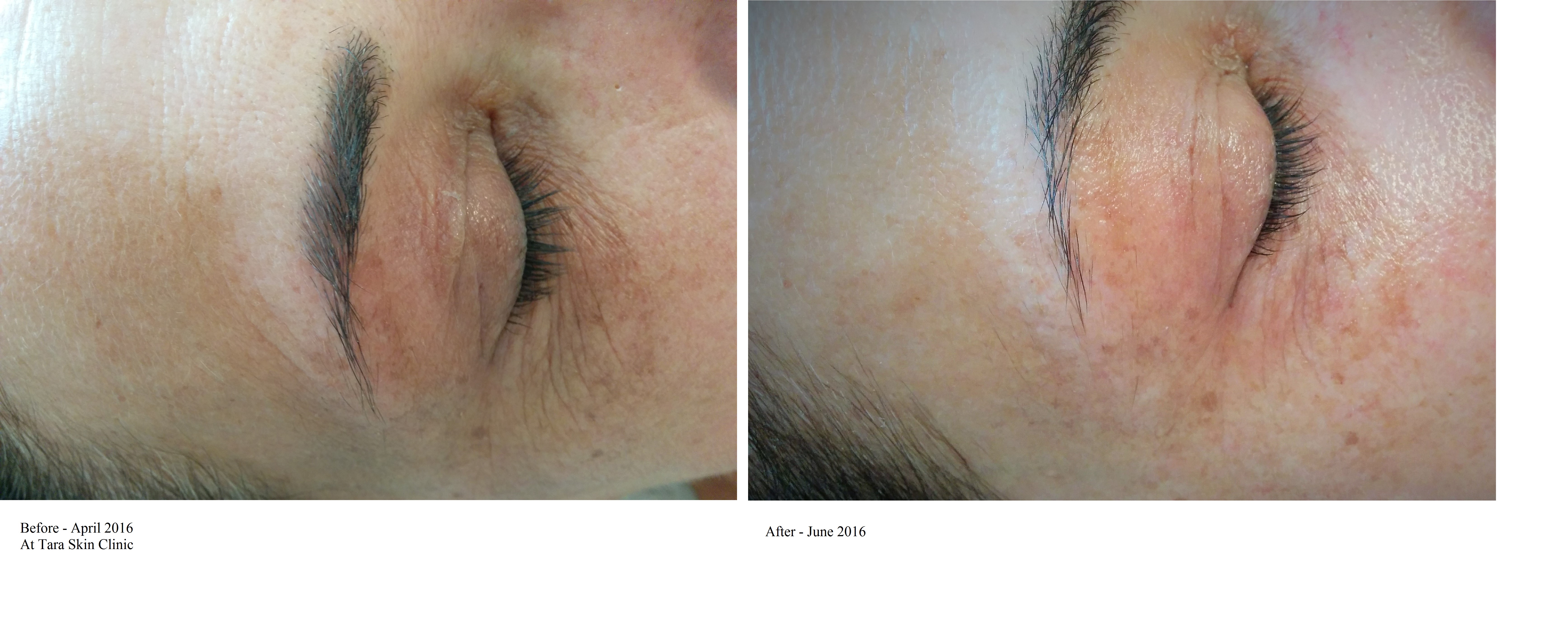 Eye treatment targeting fine lines and hyper-pigmentation 
