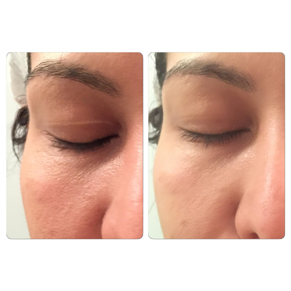 Before & after two treatments