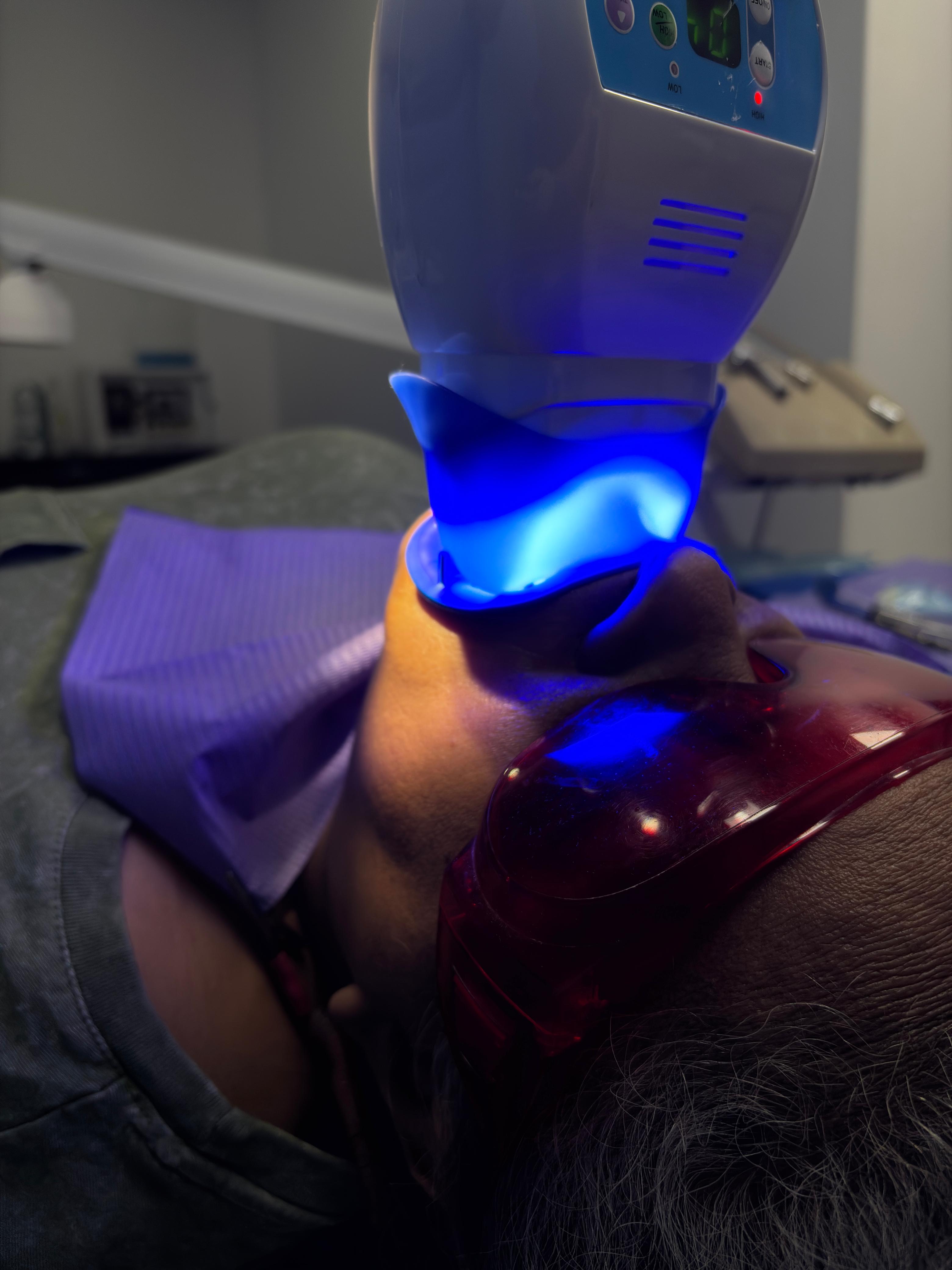 blanqueamiento laser