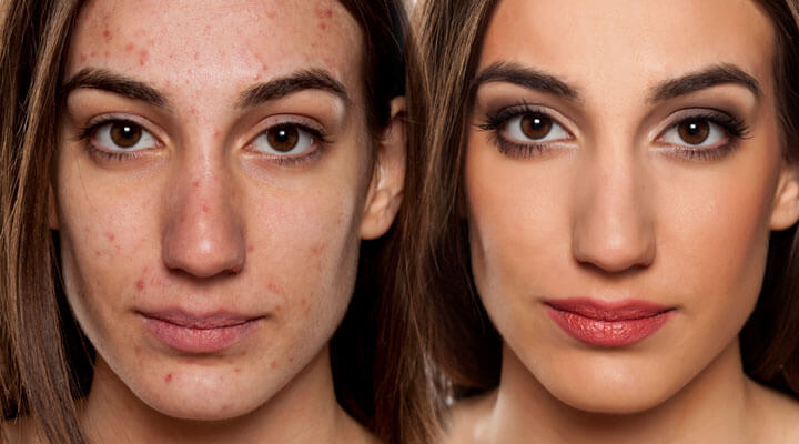 Dermatología Integral "Medica Grijalva"  - ACNE