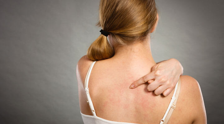 Dermatología Integral "Medica Grijalva"  - MELASMA