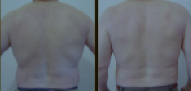 Before and After Treatment 5