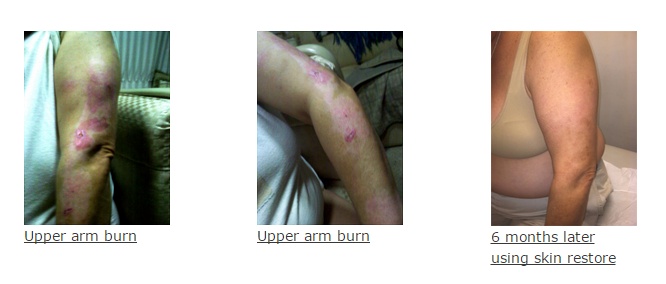 Upper Arm Burn
