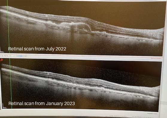 Retinal Scan of Trish's eye, upper image  taken July 2022, lower image after use of orgone energy January 2023