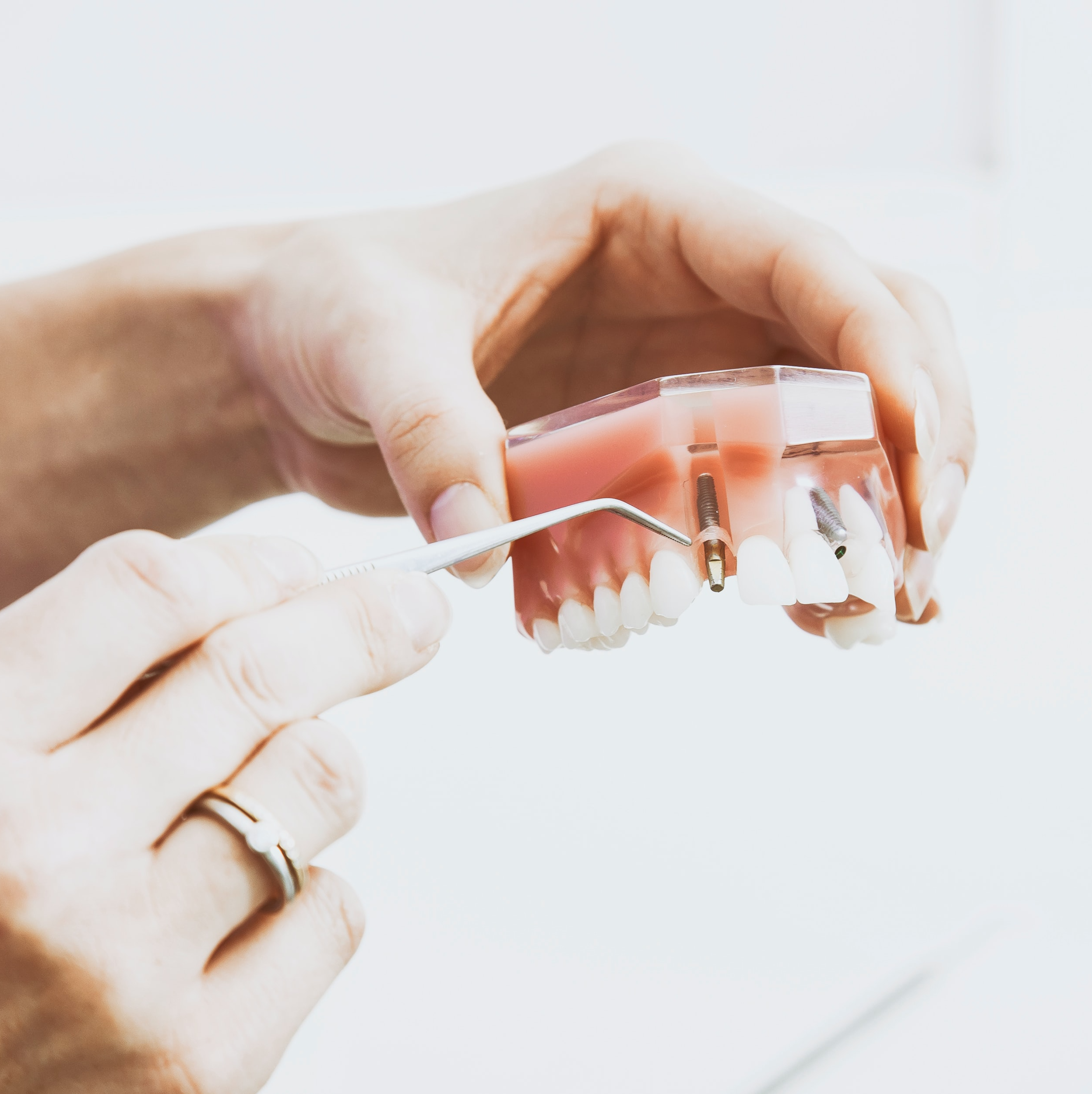 Procedimiento para poder mantener un diente en la boca antes de ser extraído.