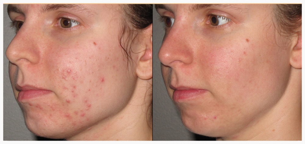 Acne Peel