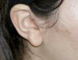 DESPUÉS (12 SESIONES)