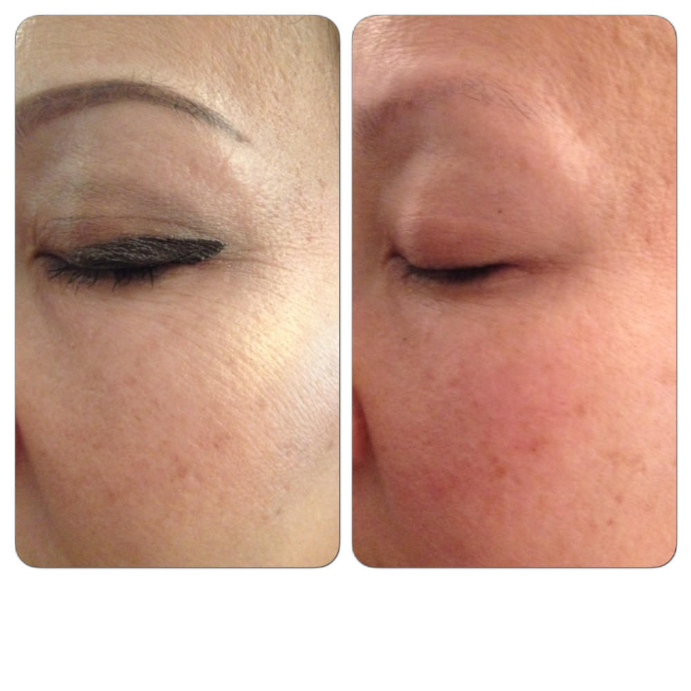Before & after one treatment
