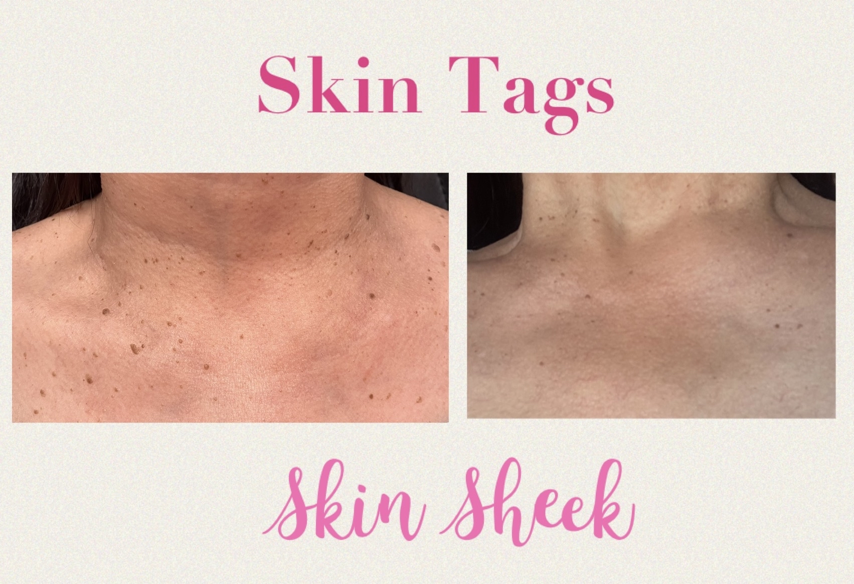 SKIN TAGS