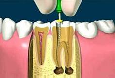 Endodoncia