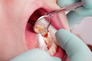 how to tell if you have cavities - dentist examining tooth using tool