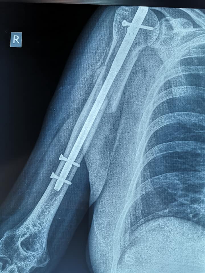 Radiografía del brazo derecho con clavo intramedular en el húmero.