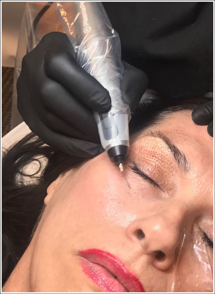 Fibroblast Plasma Pen Non Surgical Lift Treatment in Palm Harbor FL