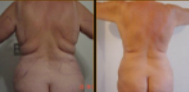 Before and After Treatment 3