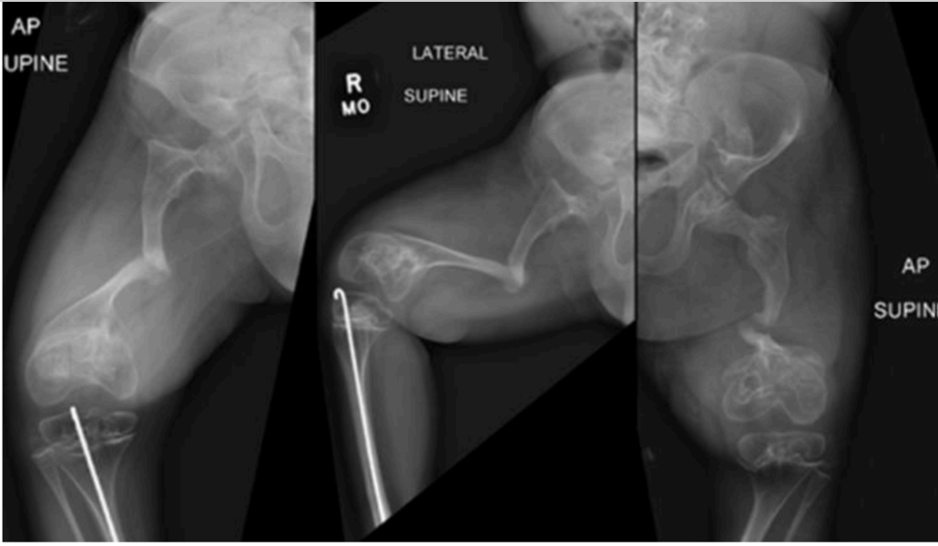 Figure 1. Images of an 8-year-old patient with severe type III OI who has experienced multiple femur fractures over time that were treated without surgical fxation. Note the signifcant deformity, nonunion, and developing pseudoarthrosis. OI, osteogenesis imperfecta.