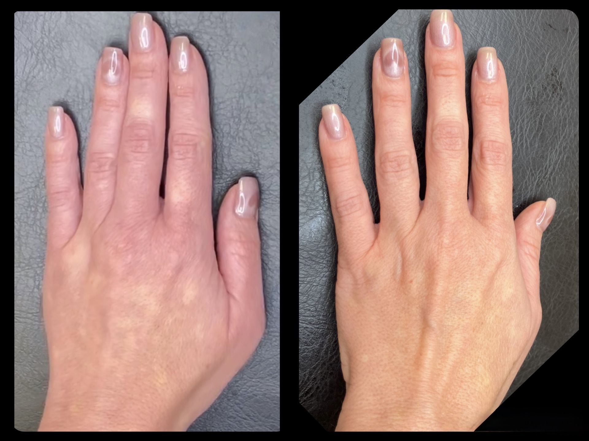 BioRePeelCl3 - Gold 
1 treatment