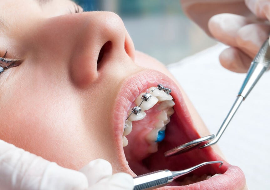 Dental Ortodoncia, Dr. Eduardo Noé Garcia Castañeda - BRACKETS