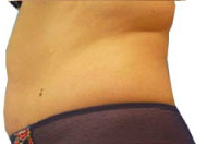 DESPUÉS (5 SESIONES)