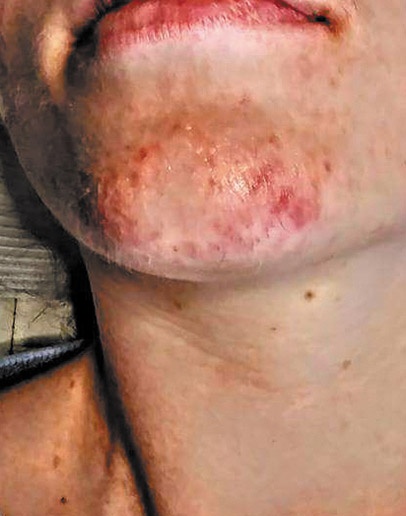 Chin Hair Removal (Before)