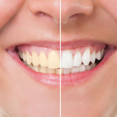 Consultorio Dental del Dr. Fernando Manuel Ortegón Mireles - BLANQUEAMIENTOS