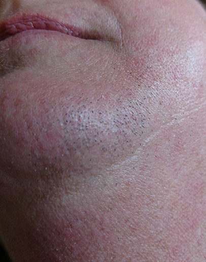 Chin Hair Removal Treatment (Before)