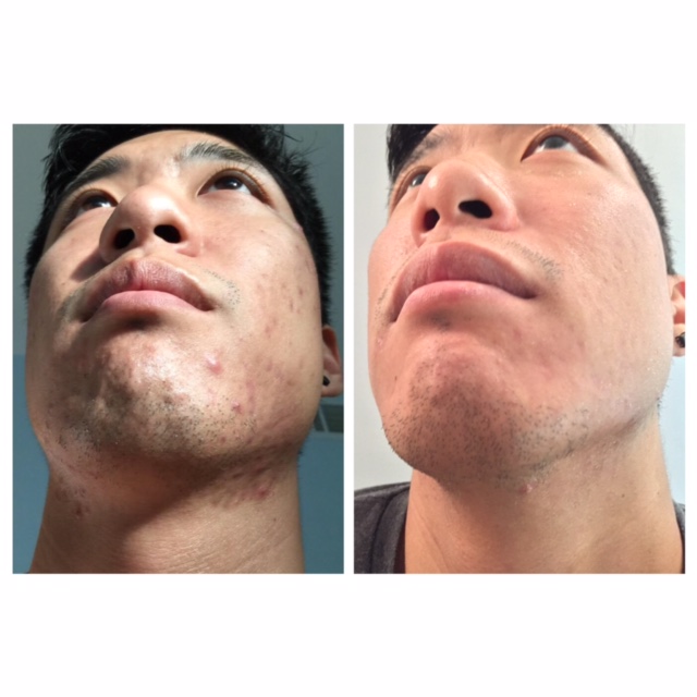 Before and after 8 weekly Micro-benefit Peels
