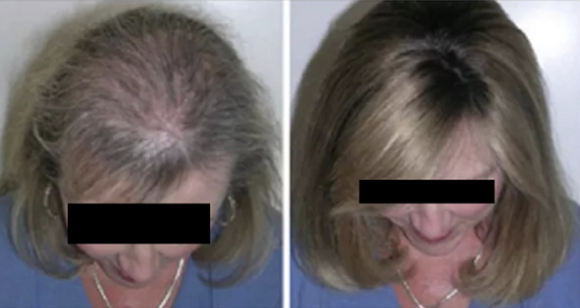 Hair Loss Treatment Temecula Weight Management