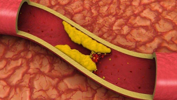 Dr. Guillermo Rafael Aceves Tavares - HIPERTENSION ARTERIAL