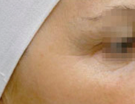 DESPUÉS (12 SESIONES)