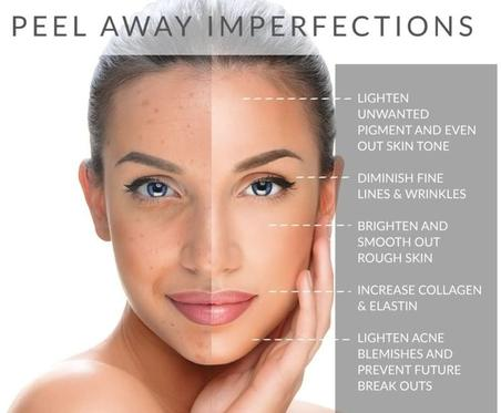 Anti-Aging TCA  Acid Peel (Trichloroacetic Acid) peel