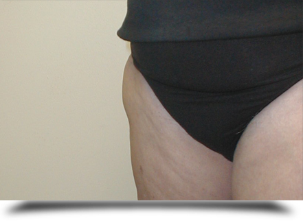 ||||After - 6 weeks after the therapy almost complete recovery