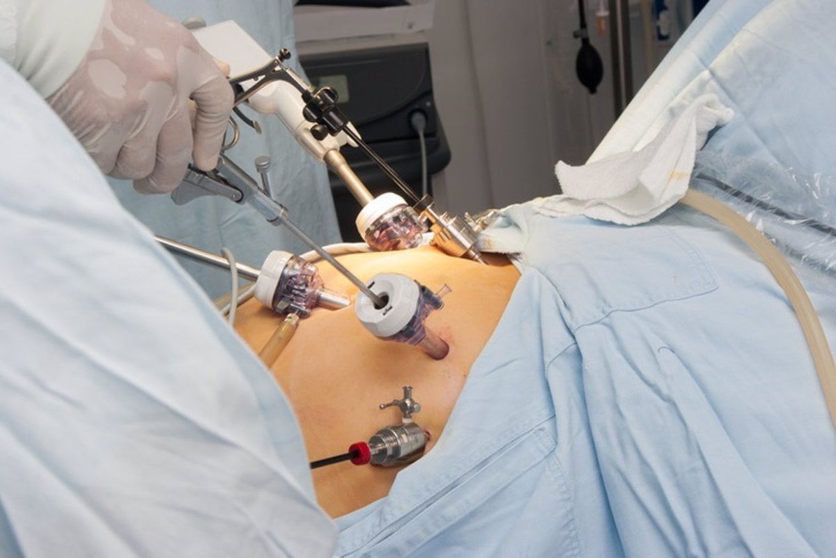 Cirugía laparoscópica en el abdomen de un paciente, mostrando herramientas quirúrgicas y puertos de acceso.